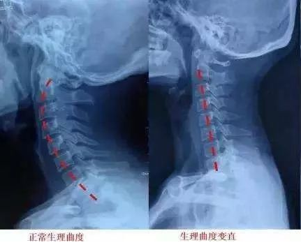 可怕！因为长时间低头玩手机，十岁男孩的颈椎竟然变成一条直线！-薛医生