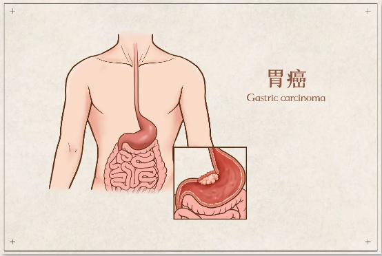 胃癌在线问诊
