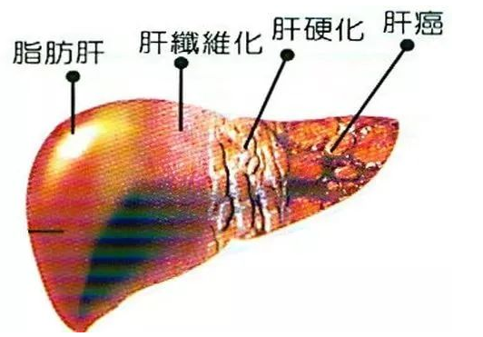 脂肪肝在线问医生
