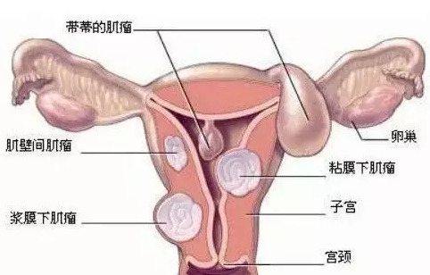子宫癌在线问医生