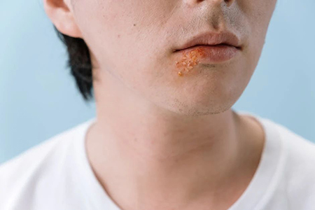 以为嘴角是上火起的水泡，竟然是病毒感染！还是会传染的“单纯疱疹”！