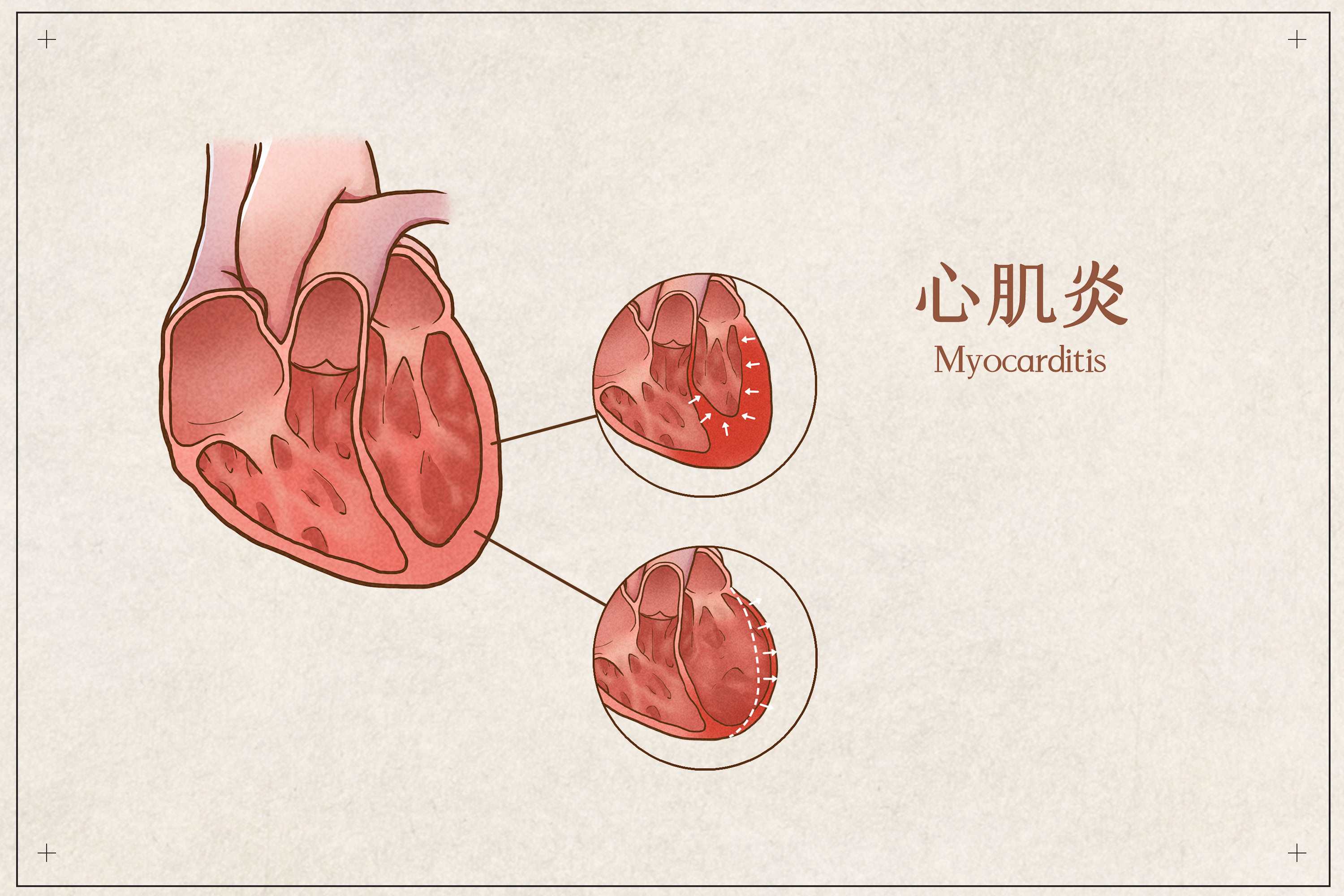 怎么判断自己得了心肌炎